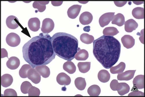 ) The distinction among the lymphoma types typically requires immunophenotyping. Image 8: Follicular lymphoma Image 9: Sezary cell (Source: Figure HE-11. In: Glassy EF, ed. Color Atlas of Hematology.