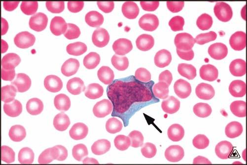 A peripheral blood smear may contain a subset of lymphoma cells amidst a background of small lymphocytes, but those lymphoma cells will resemble one another.