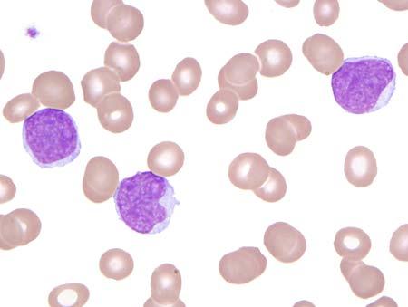acute leukemia. Typical mantle cell lymphoma cells are larger than lymphocytes with folded nuclei and a small amount of basophilic cytoplasm.