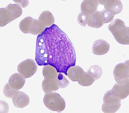 Burkitt Lymphoma Burkitt or Burkitt-like lymphoma cells are morphologically identical to the cells seen in Burkitt leukemia.
