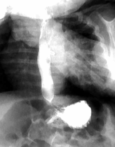 Thoracoscopic repair of esophageal atresia with a distal fistula lessons from the first 10 operations The fistula was closed with 1 stitch, and the later course was uncomplicated.