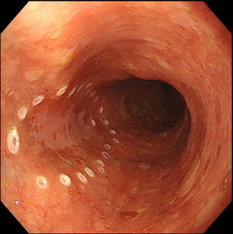 Page 6 of 12 Purchiaroni et al. Quality in upper GI ESD Mucosal incision Figure 3 Marking of SCC in the mid esophagus. SCC, squamous cell carcinoma.