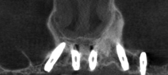 Figure 10: Postoperative CBCT showing final implant position.