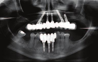 Int J Periodontics Restorative Dent 15(4): 344-61 Sanna AM, Molly L, Van Steenberghe D (2007) Immediately loaded CAD-CAM manufactured fixed complete dentures using flapless implant placement