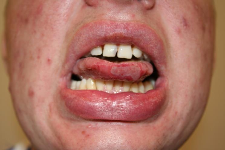 ulcers Angular cheilitis Glossitis