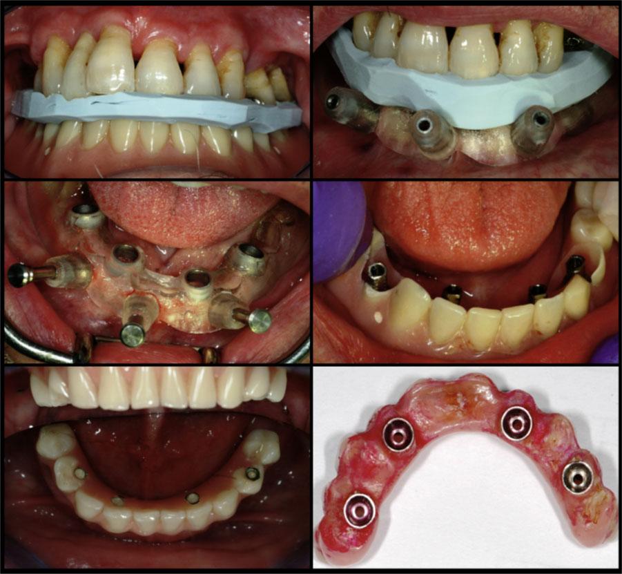 4 Clinical Implant Dentistry and Related Research, Volume *, Number *, 2014 A B C D E F Figure 1 Clinical procedure for application of the All-on-4 concept.