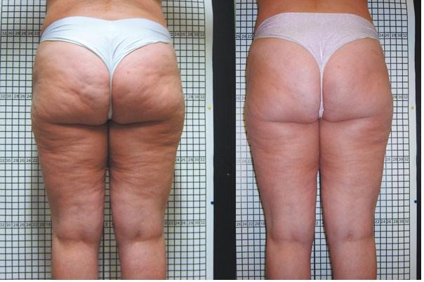 Fibrotic CELLULITE The following Clinical Experiences suggest 8 sessions on a weekly basis for best results for Cellulite The number of sessions varies according to the imperfections to be treated