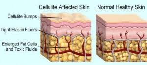 WHAT IS CELLULITE? Cellulite is a popular term to describe fat deposits under the skin.