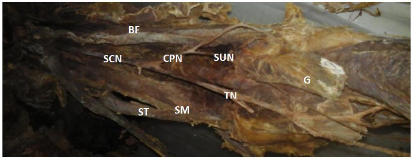 CPN: common peroneal nerve; ut: unsual trunk SUN: sural nerve; PVV: popliteal vessel; G: two heads of gastrocnemius muscle; SM: semimembranosus; BF: Biceps