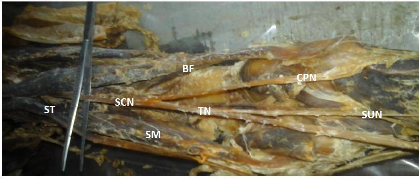 Dissection of the right popliteal fossa showing furcation of the sciatic nerve (SCN: sciatic nerve dividing low in the popliteal fossa; TN: tibial nerve; CPN: