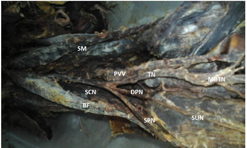 PVV: popliteal vessel; SM: semimembranosus; BF: Biceps Femoris; ST:Semitendinous Figure: 5.