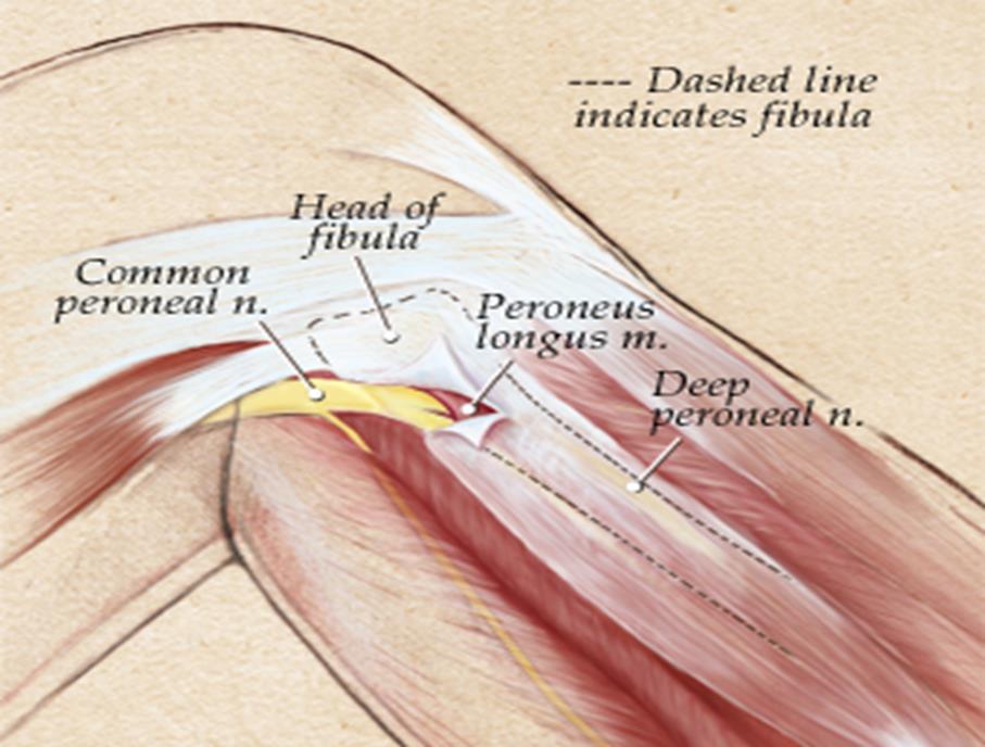 common fibular nerve (common peroneal nerve; external popliteal nerve; lateral popliteal nerve). Root Value: (L4, L5,S1,S2) About one-half the size of the tibial nerve.