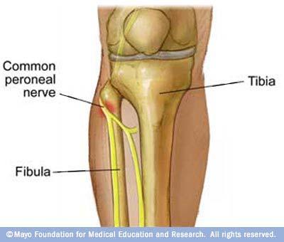 Common Peroneal Nerve Injury Results from Fractures of the neck of the fibula Paralysis of the muscles of the anterior and lateral