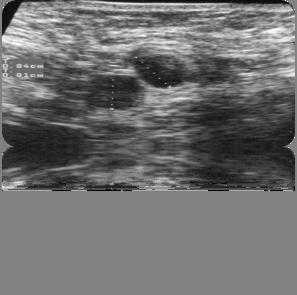Axillary staging Physical Examina8on