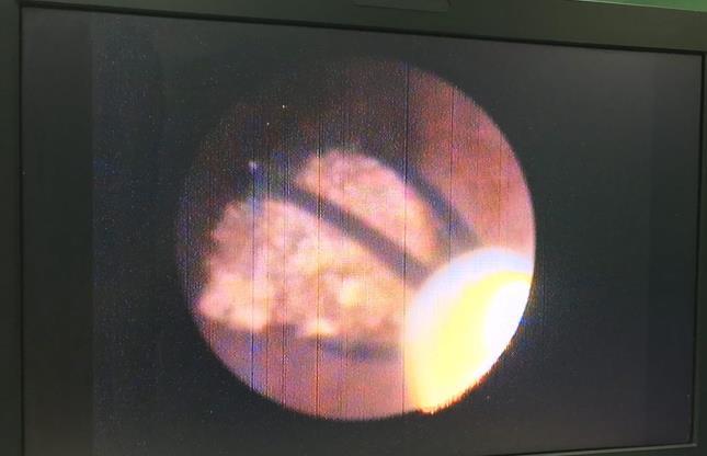 We perform basket stone extraction under direct ureteroscopic vision for 64 patients (64 from 69 patients). Stone was located in the proximal, middle and distal of ureter, respectively in 8 (12.