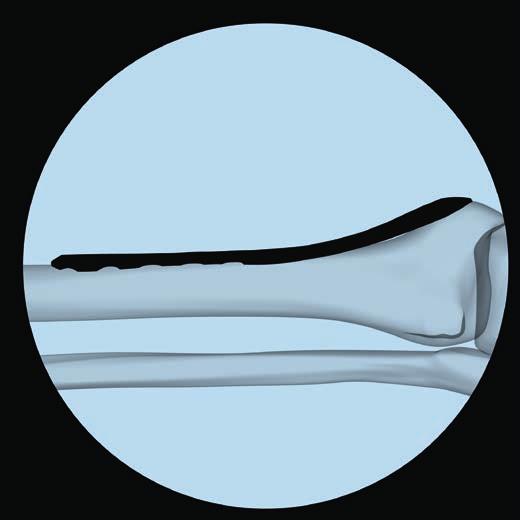 2 Position plate and fix provisionally After plate insertion, check alignment on the bone using fluoroscopy. Make any adjustments before inserting screws.