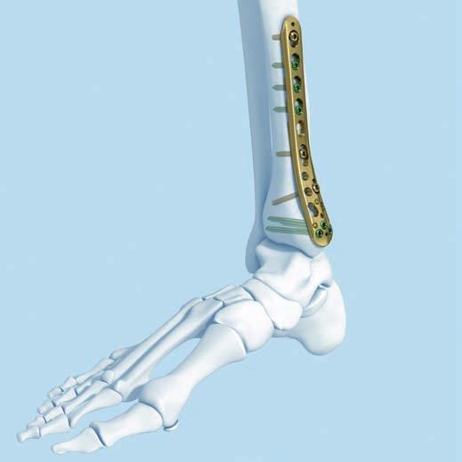 LCP Low Bend Medial Distal Tibia Plates 3.5 mm The LCP Low Bend Medial Distal Tibia Plate 3.