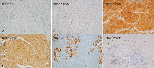 B, BRAF V600K-mutated melanoma, which is negative for VE1 (brown melanin pigment is present in a few melanoma cells). C, BRAF V600E-mutated melanoma strongly positive for VE1.