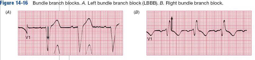 14.4 Bundle Branch Block (Cont d) 25