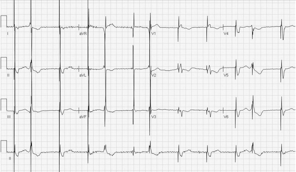 Biventricular pacemaker 1. Undersensing 2.