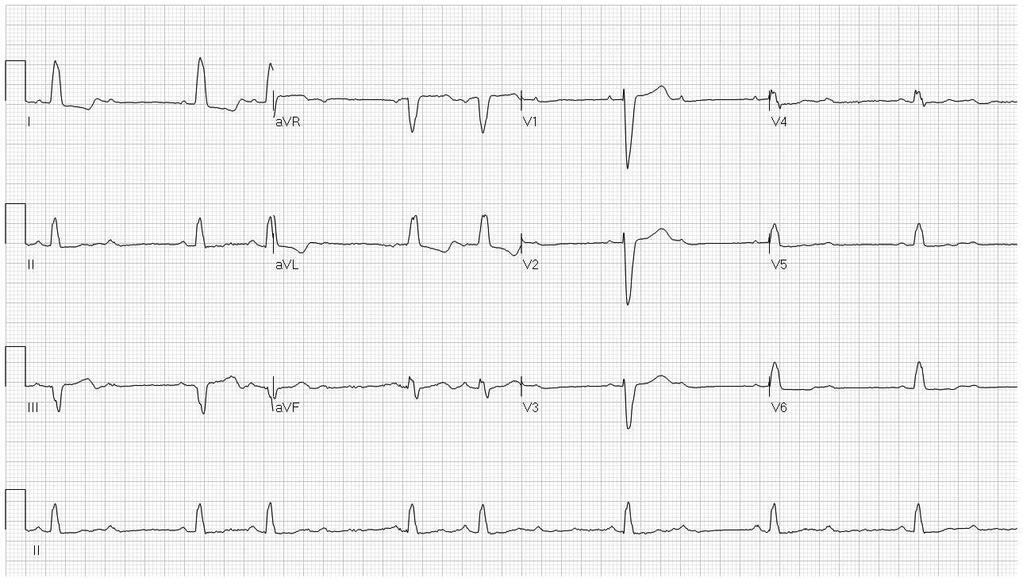 71 year old woman, 2 episodes of syncope. The conduction disturbance is most likely 1.