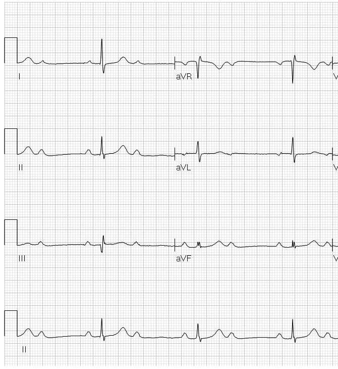 2:1 AV conduction. The conduction disturbance is most likely 1.