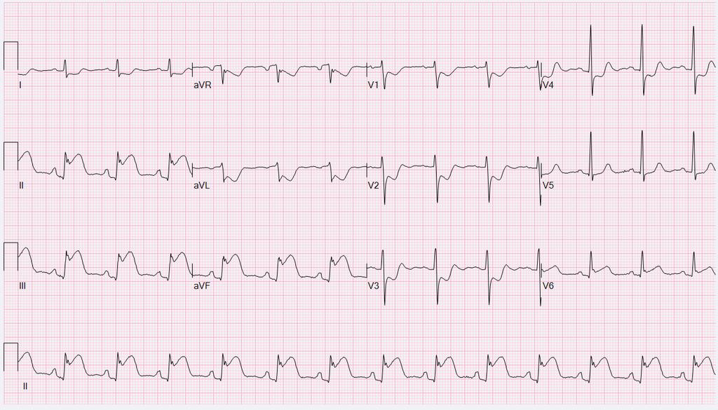 58 year old man, chest pressure, short of breath 1. Pericarditis 2.