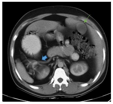 Figure 4: Axial CECT Showing Gallbladder (Arrow) to Left