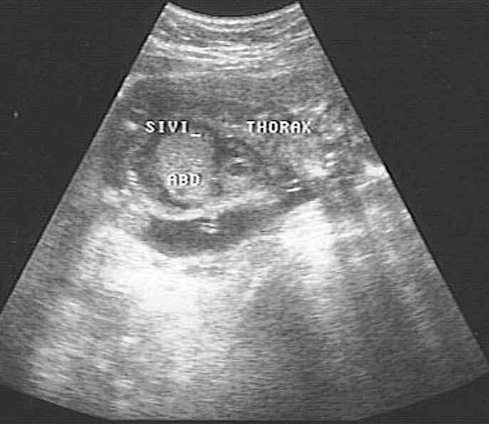 Perinatal Journal Vol: 15, Issue: 1/April 2007 43 The usual positioning of these organs are situs solitus and a mirror-image reversal of this arrangement is situs inversus.