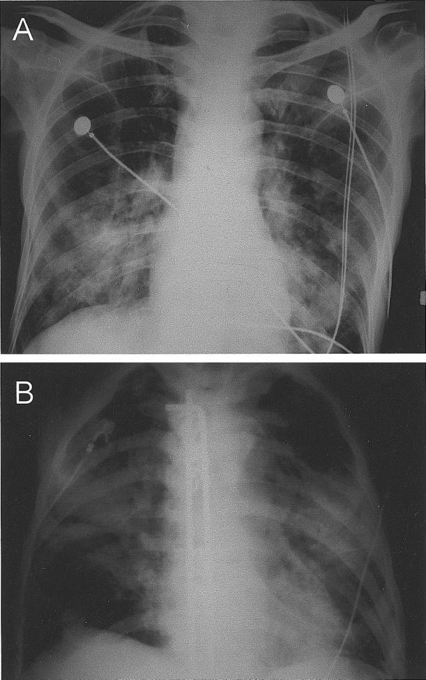 Figure 2. Chest radiographs of the 2 patients who died of coronavirus HKU1 associated community-acquired pneumonia.