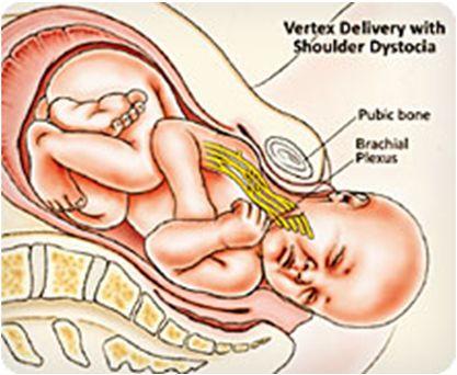 7. Birth Trauma Shoulder dystocia