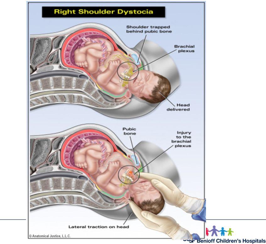 8. Neurologic Issues CNS damage from: Asphyxia Birth