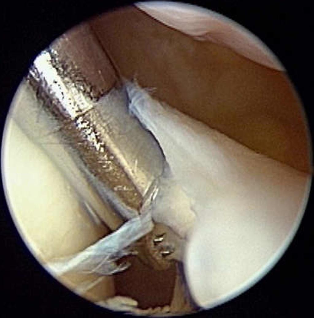 Arthroscopic cartilage regeneration facilitating procedure for