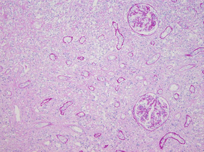 4 (d) (e) (c) (f) (g) Figure 2: The first renal biopsy showed almost normal glomeruli, massively infiltrating cells, severe tubular