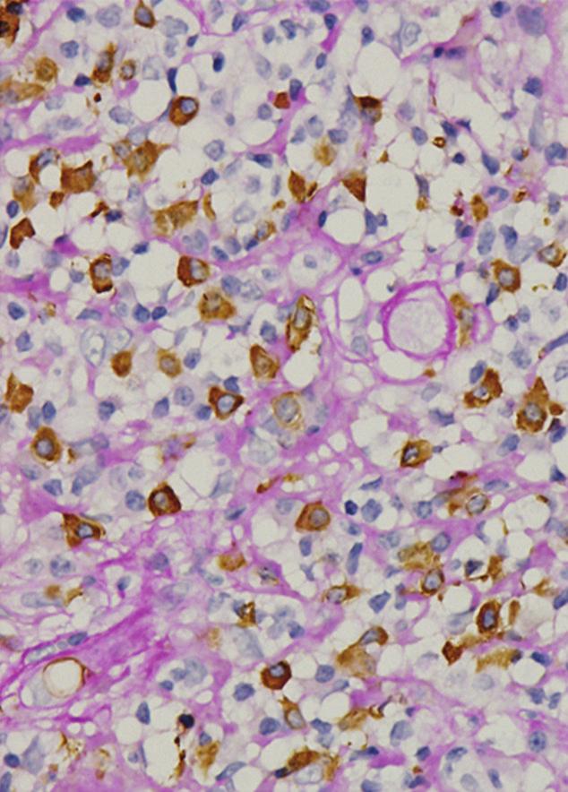 6 (c) (d) (e) (f) Figure 4: Retrospective immunostaining of the first renal biopsy tissue revealed high numbers of IgG4-positive plasma cells in the interstitium (, 4).