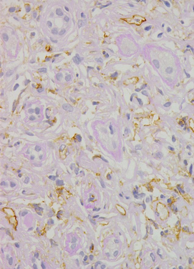 In the rebiopsied renal tissue with an area of 1.44 m2, no cell infiltration and fibrosis was observed.