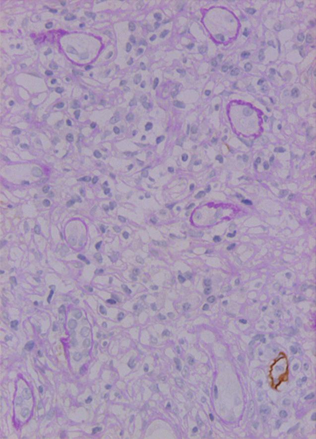 All the above results suggest clinical and pathologic improvement in this case. Fibrosis is considered a histopathological indicator of poor prognosis [11 13].