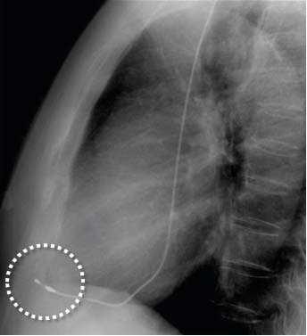 antitachycardia burst pacing. After the event, he felt left chest pain, which was aggravated by deep inspiration.