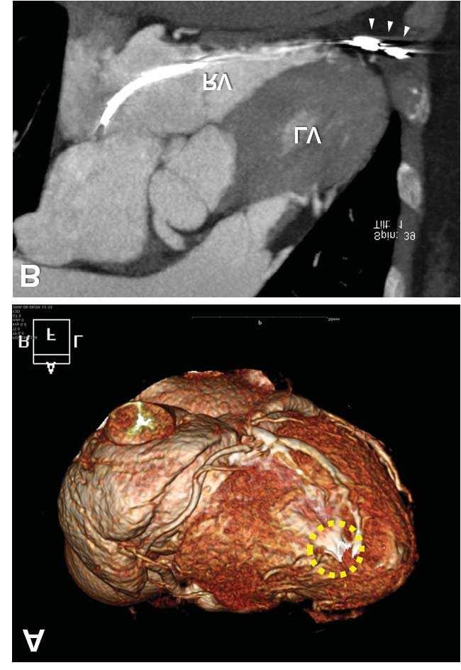 Cardiac Perforation Associated with a Pacemaker or ICD Lead 345 lead repositioning was performed.