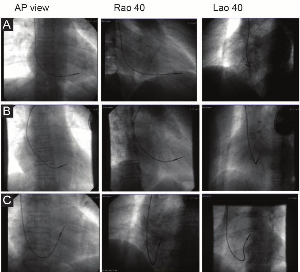LV dyssynchrony by speckle tracking in patients with permanent pacemaker 80% pacing at follow up (by pacemaker interrogation or in 2 ECGs taken at two different times) and who provided consent for