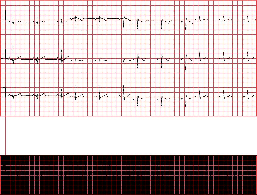 Measurments Heart Rate 61 bpm P Duration 77 ms ECG Report PR Interval 155 ms