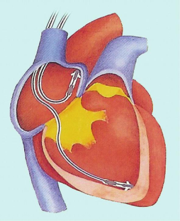 Cardiology Research and Practice 5 Aring-vtip TVI (a) Aring-vring TVI (b) Figure 3: Trans Valvular Impedance (TVI) system (Medico, Italy).