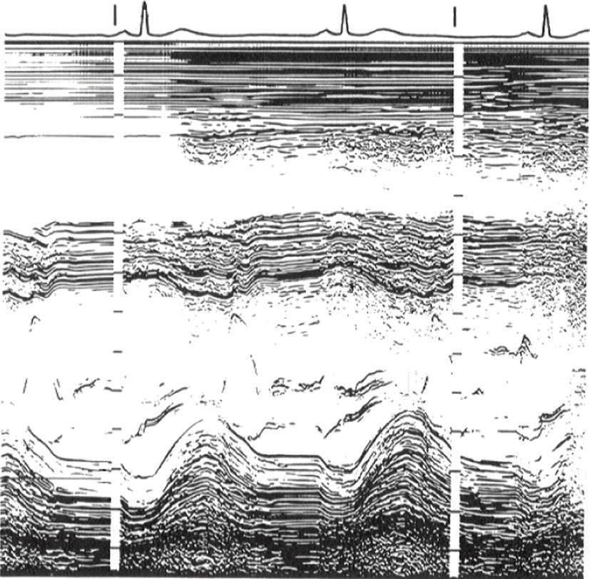 1sec ECG 1cm IVS AEGM Endocardium Dd Ds VEGM WT Epi TVI (a) Echocardiograph in an adult to show measurement of ventricular dimensions.