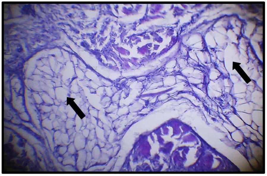 Year 2016 21 Figure 12 : Photomicrograph of skin tissue from Group III showedvacuolar degeneration of Schwann cells of the peripheral nerve(black arrows)(h&e X400). V.