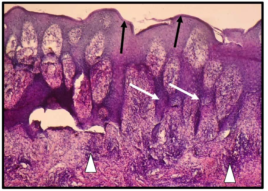 b) Ininsulin dependent diabetes (IDD) Mild hyperkeratosis in the epidermis (increase thickness of the keratin layer of the epidermis) with regular acanthosis due to hyperplasia of the stratum