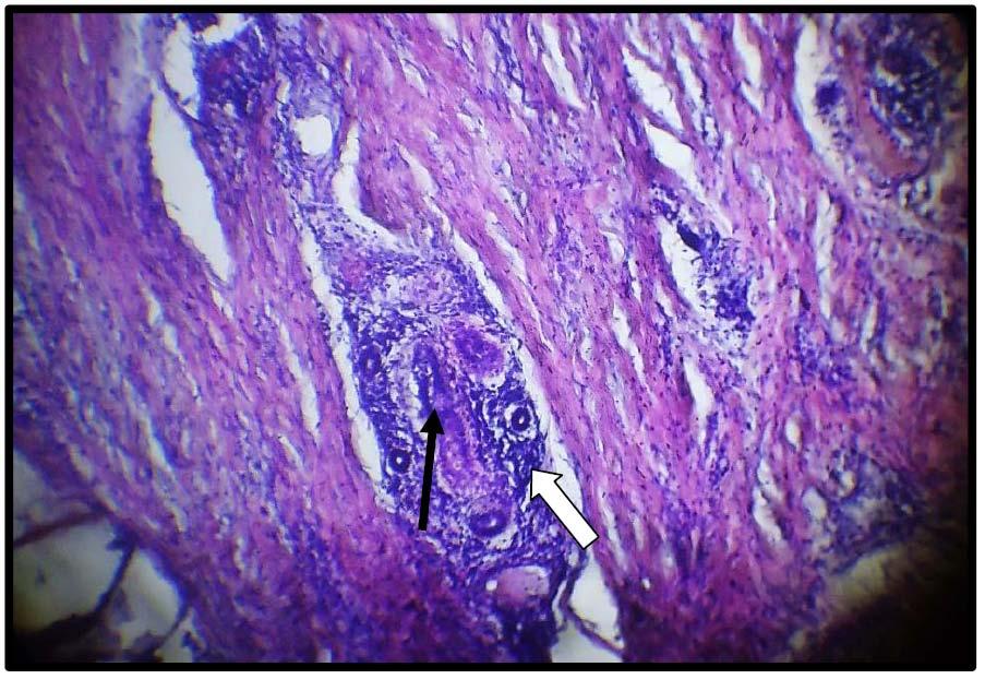 Volume XVI Issue 1 Version I Year 2016 16 Figure 2 : Photomicrograph of skin tissue from Group II showedmild hyperkeratosis in the epidermis(black arrows) with regular acanthosis(white arrows)