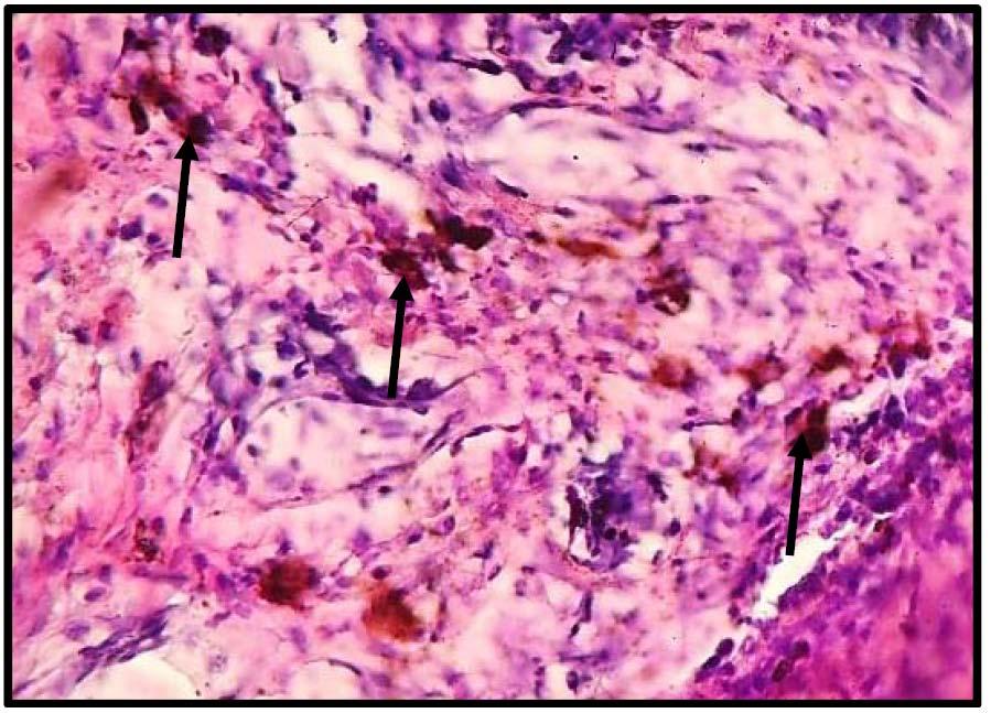 18 Volume XVI Issue 1 Version I Year 2016 Figure 6 : Photomicrograph of skin tissue from Group II showedfocal melanin pigmentation in the dermis(black arrows)(h&e X150).
