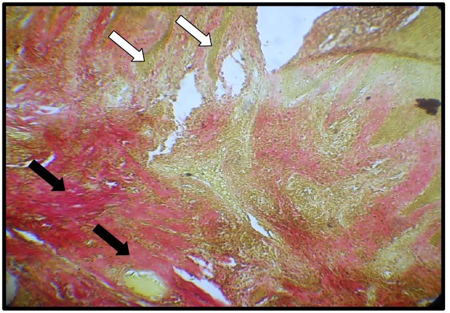 19 Figure 8 : Photomicrograph of skin tissue from Group Ishowedhyperacanthosis of epidermis (white arrows) with heavy collagen fiber deposition around the blood vessels (black