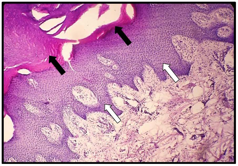 c) In Non-insulin dependent diabetes (NIDD) Marked hyperkeratosis more than insulin dependent diabetes appeared as thickened keratin covering the epidermis with obvious sever acanthosis
