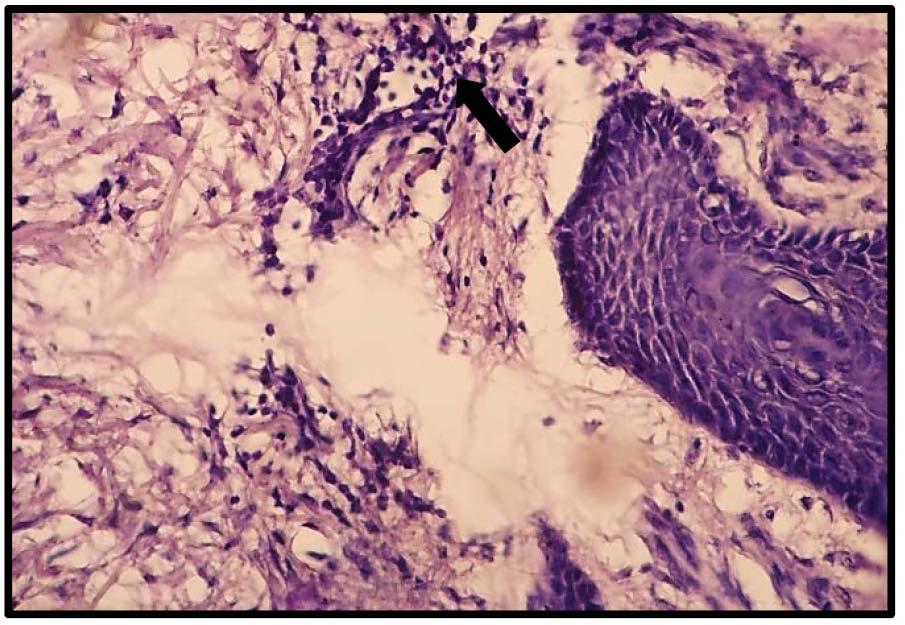 20 Volume XVI Issue 1 Version I Year 2016 Figure 10 : Photomicrograph of skin tissue from Group III showedmild inflammatory cells deposition in thedermis (black arrow)(h&e X150).